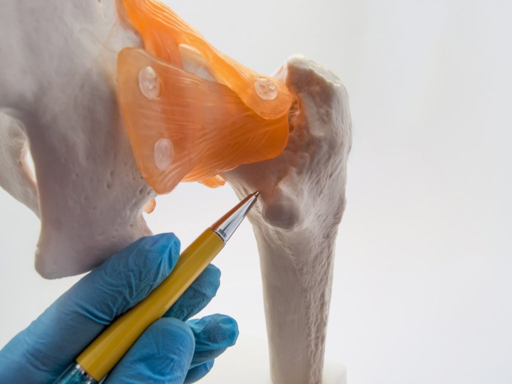 أعراض كسر عنق الفخذ