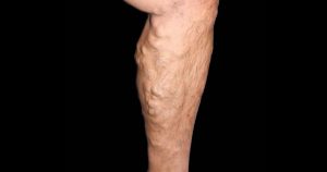 دوالي الساقين تزيد خطر جلطة الساق والانسداد الرئوي