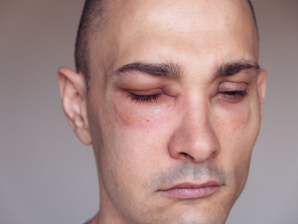 ما هي الوذمة الوعائية الوراثية؟