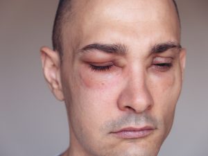 ما هي الوذمة الوعائية الوراثية؟