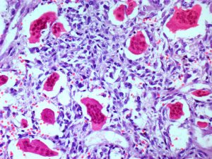 أطباء: الصيام لتجويع خلايا السرطان هو تضليل