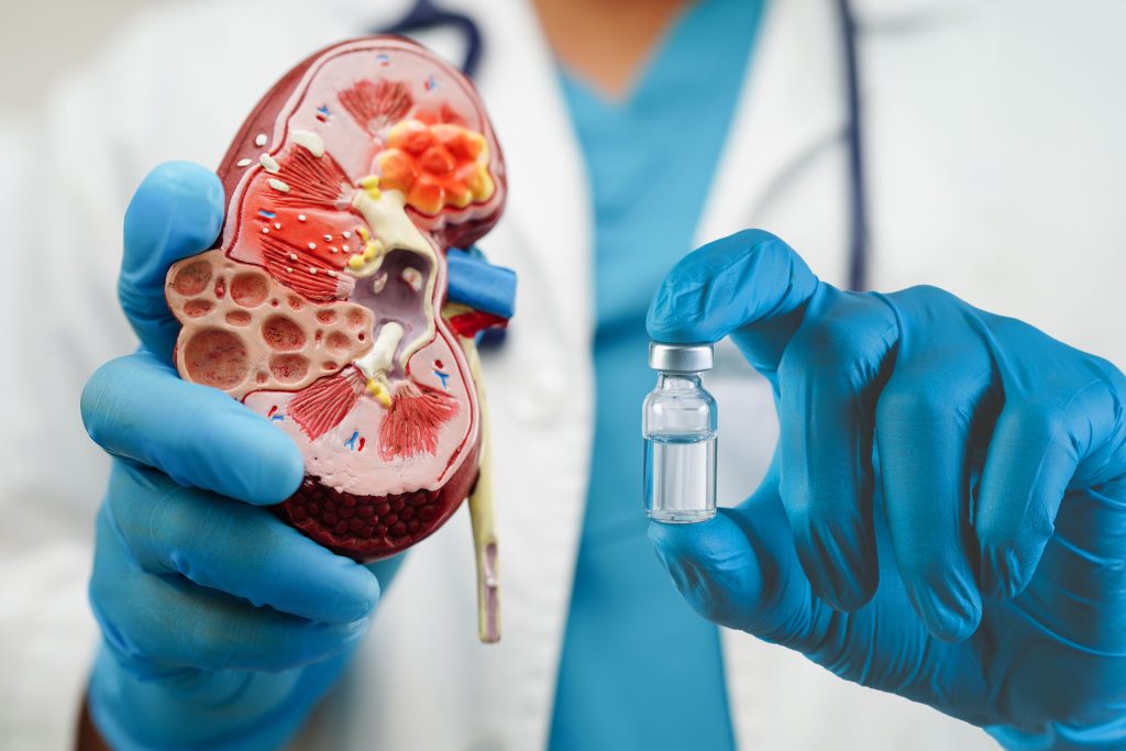 اكتشاف رائد لتشخيص وعلاج الفشل الكلوي المزمن