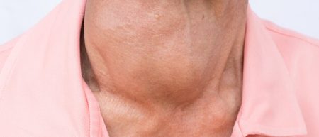 أستاذة بالطب توضح أثر اضطرابات الغدة الدرقية على الوزن